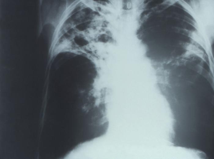 County Health Officials Report 17% Increase in Tuberculosis Cases
